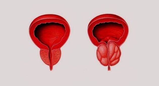 Prostata osasuntsua (ezkerrean) eta hanturatua prostatitisaren ondorioz (eskuinean)
