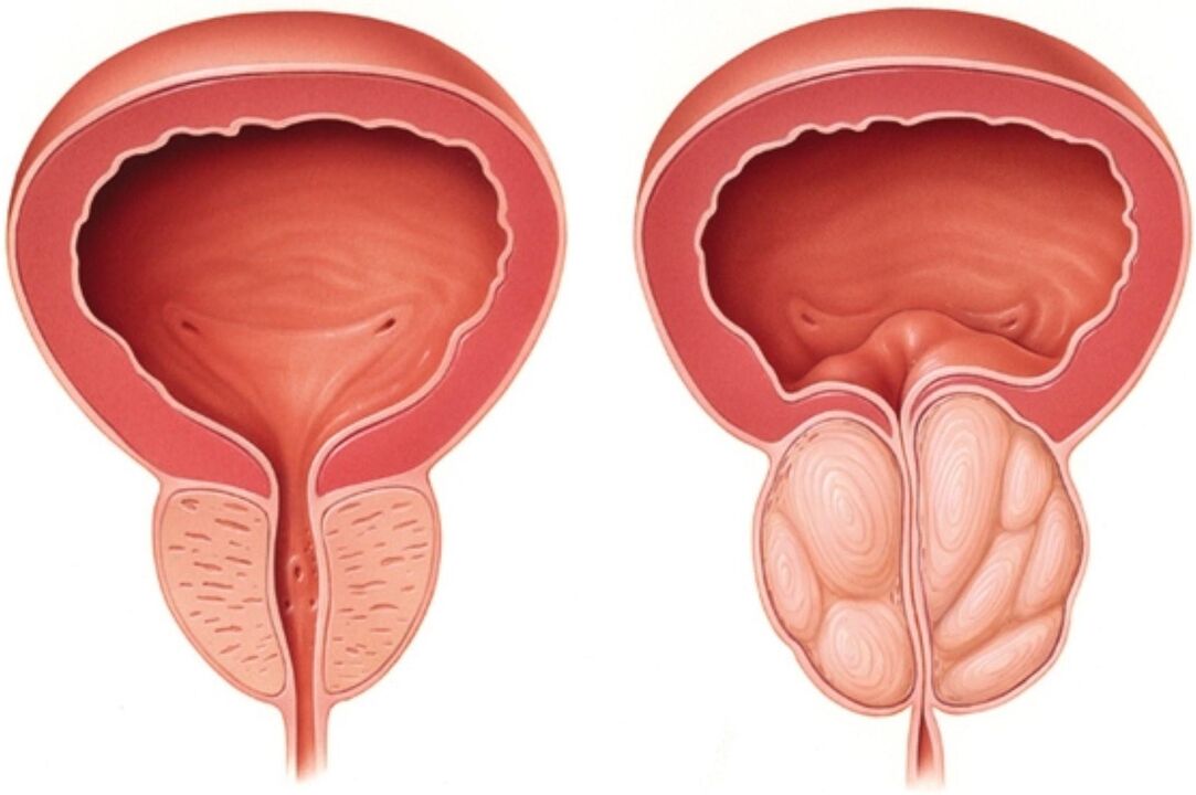 Prostatako normala (ezkerrean) eta hantura zantzuekin prostatitisan (eskuinean)