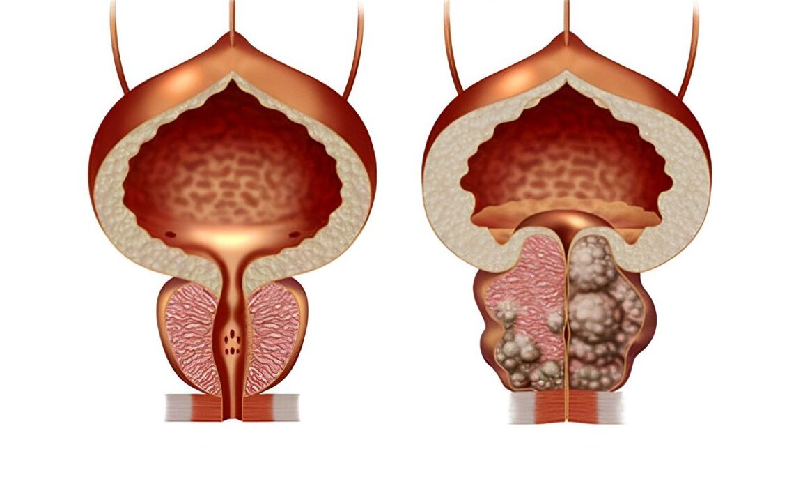 nolakoa da prostatako adenoma 