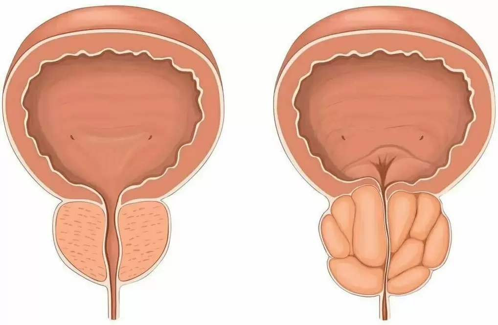 Prostatako eta prostatako mina normala