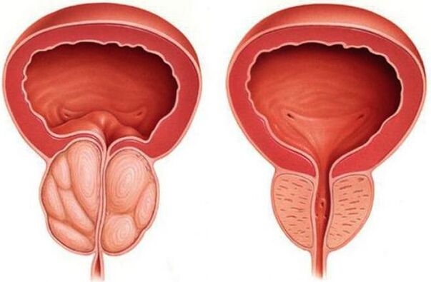 prostatitisarekin prostata osasuntsu eta hanturatuta